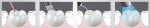 کامپوزیت فیشور سیلانت BeautiSealant شوفو
